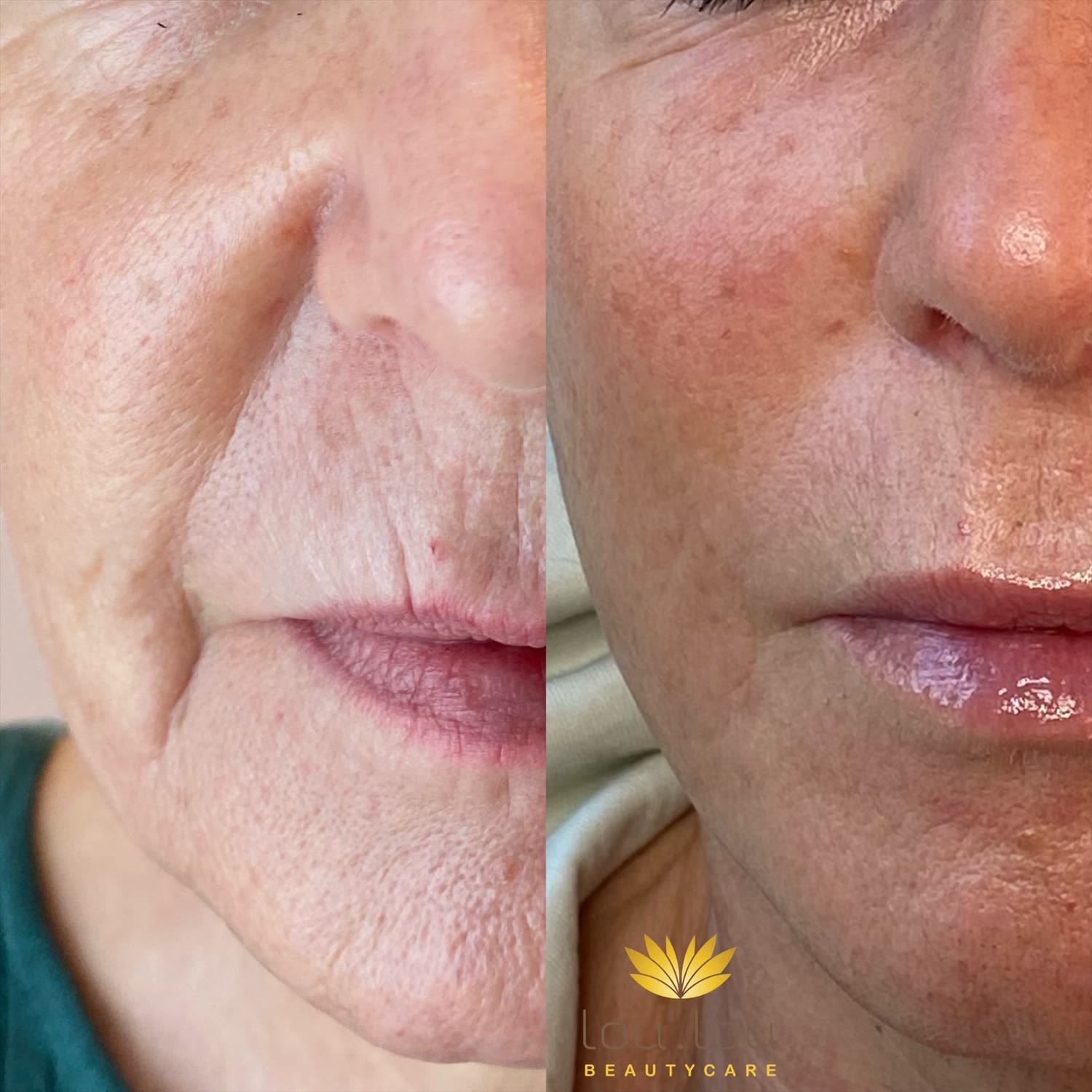 Vorher und nachher: Stammkundin nach Mezotix, Microneedling und passender Pflege zuhause