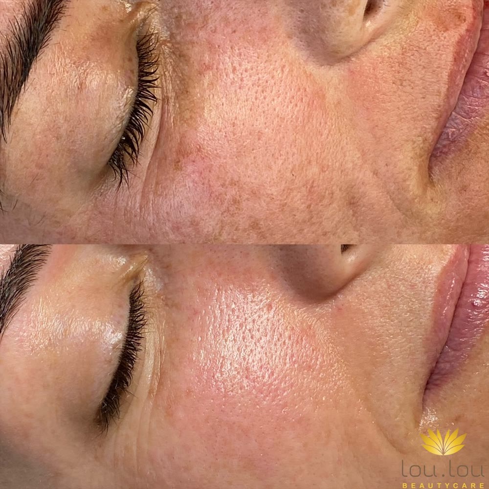 Vorher und nachher, echte Kundin von Lou.Lou Beautycare