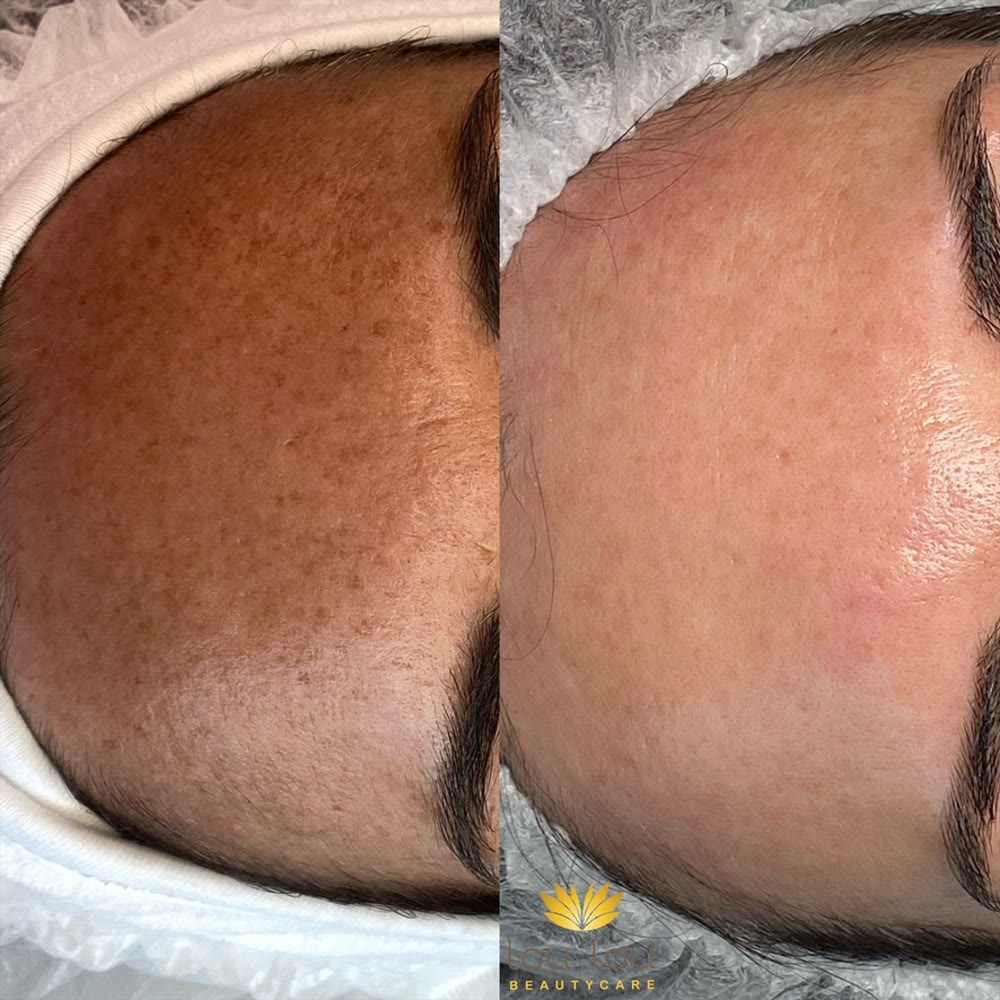 Vorher und nachher, echte Kundin von Lou.Lou Beautycare